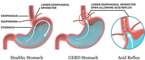 Refluks Asam Lambung (Refluks Gastroesofageal) Penyebab, Gejala ...