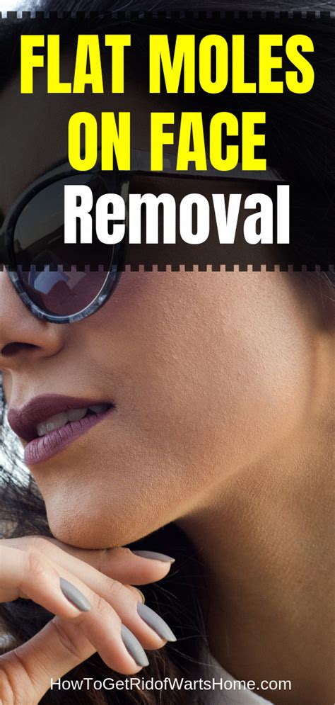 Flat Moles on Face Removal: Can flat moles be removed? How is it done? If you have flat black ...