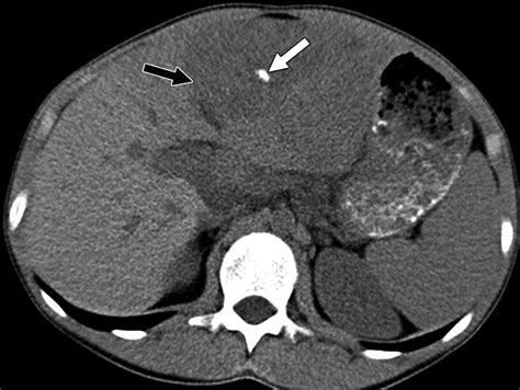 Liver Calcifications and Calcified Liver Masses: Pattern Recognition Approach on CT | AJR