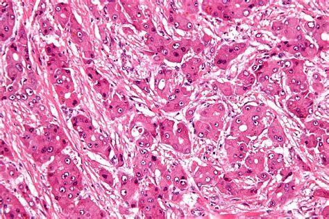 File:Fibrolamellar hepatocellular carcinoma - high mag.jpg - Wikimedia ...