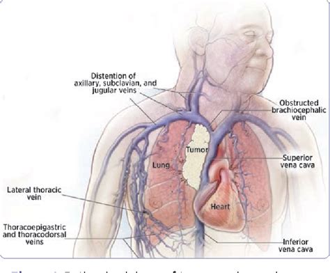 [PDF] Superior Vena Cava Syndrome in the Cancer Patient: A Case Study | Semantic Scholar