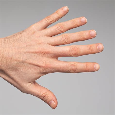 How can polydactyly happen when it’s not inherited? - The Tech Interactive