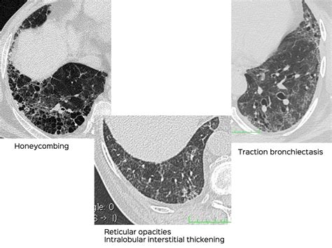 Interstitial Lung Disease - CT Chest Review