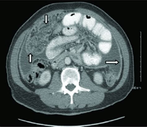 Computed tomography scan of abdomen showing moderate amount of... | Download Scientific Diagram