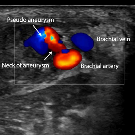 Pseudoaneurysm - Critical Care Sonography