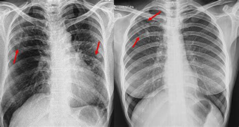 Chest X-ray for Screening for Tuberculosis