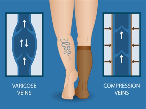 How Do Compression Socks Help My Varicose Veins? - Denver Vein Center