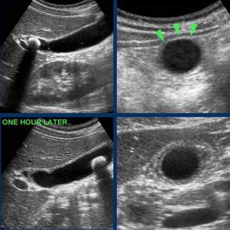 Diseased Gallbladder Ultrasound