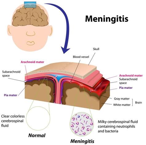 Viral meningitis csf gram stain - Answers on HealthTap