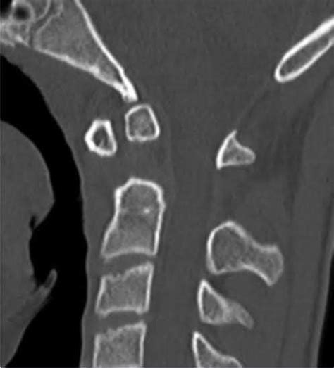 Os Odontoideum - smooth, well-corticated ossicle at the superior ossicle of a hypoplastic dens ...