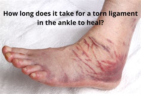 How To Heal A Torn Ankle Ligament Fast?-Great Running Advice