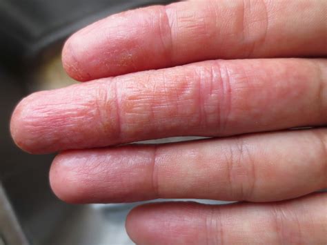 SKIN DISEASE TYPES: Vesicular Hand Dermatitis (Skin Disease type)