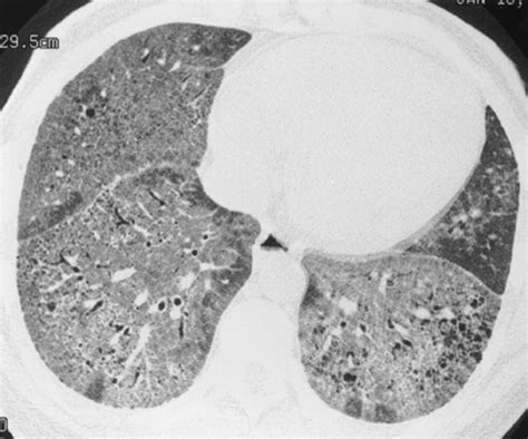 Ground Glass Associated Diseases | Lungs