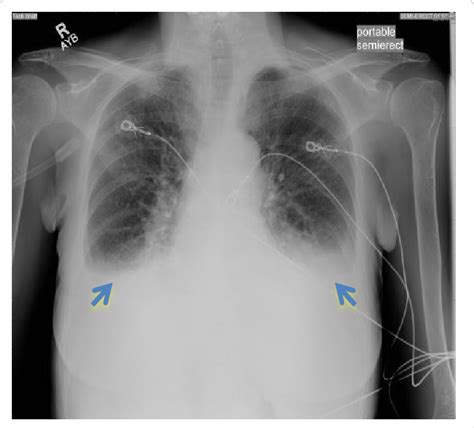 Pleural Effusion On X Ray