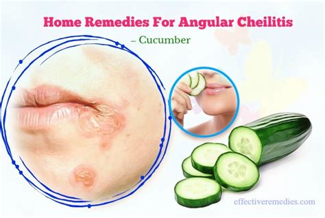 20 Home Remedies For Angular Cheilitis (Cracks In Mouth Corners)