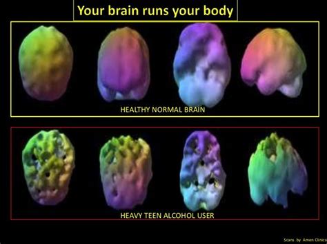 Daniel Amen Brain Scans | Agy Felvételek - Mindenütt, Mindenkinek Segíts, Jó Szóval ... | Fish ...