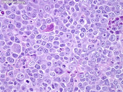 Webpathology.com: A Collection of Surgical Pathology Images