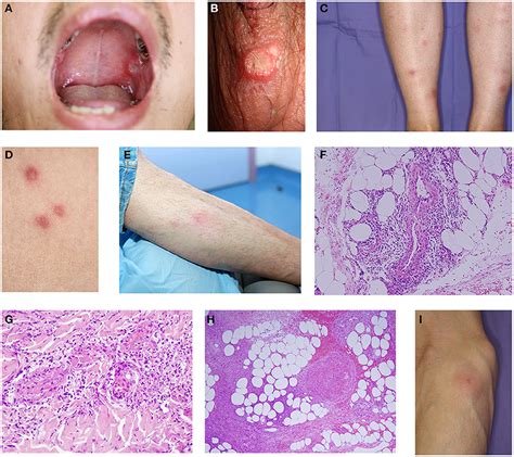 Frontiers | Mucocutaneous Manifestations of Behçet's Disease