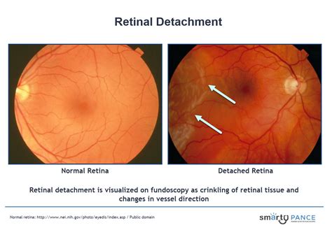 Retinal Detachment | EENT Content Blueprint - Smarty PANCE | PANRE