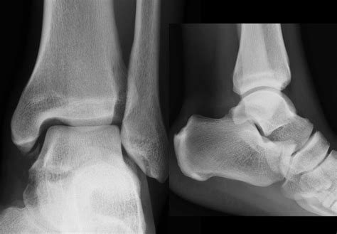 Radiograph showing chip fractures at the articular side of the medial... | Download Scientific ...