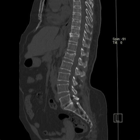 L1 Fracture / Pathologic Fractures Radsource - tohsurvey