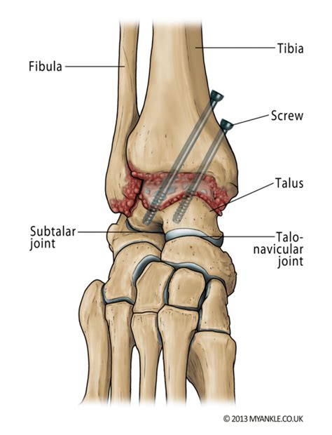 Ankle Fusion — Ankle Arthritis | Ankle Replacement | Arthrodesis ...