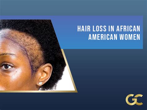 Hair Loss in African American Women - Gold City Best Hair Transplant Turkey