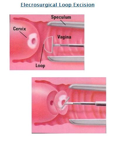 Abnormal Pap Smears – VBGYN.com