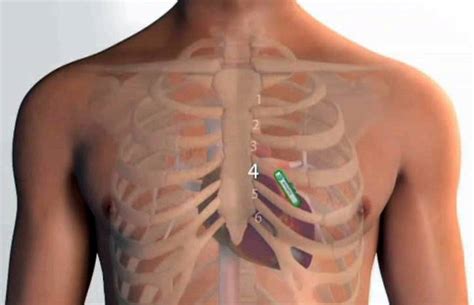 Loop Recorder Insertion - Cardiology Tasmania