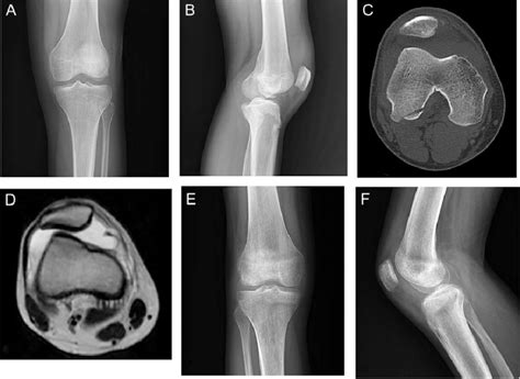 Case 2. A and B Radiography showing lateral femoral condyle OCF and ...