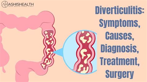 Diverticulitis: Symptoms, Causes, Diagnosis, Treatment, Surgery