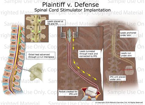 Spinal Cord Stimulator - MotionLit