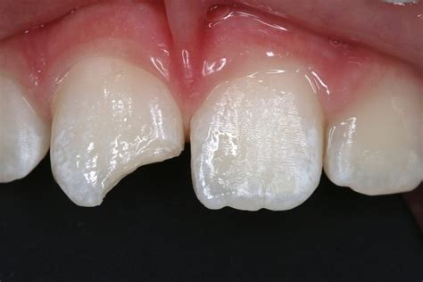 White Fillings Before and After photos - Front Tooth Composite Fillings