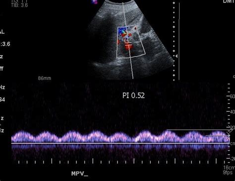 ECR 2013 / C-2537 / Color Doppler ultrasound flow patterns in hepatic ...