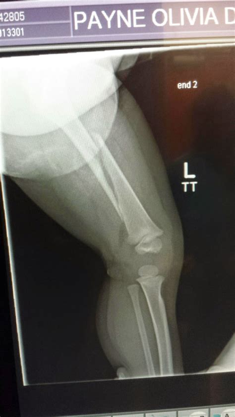 Caring for the Hip Spica Cast : Broken Femur