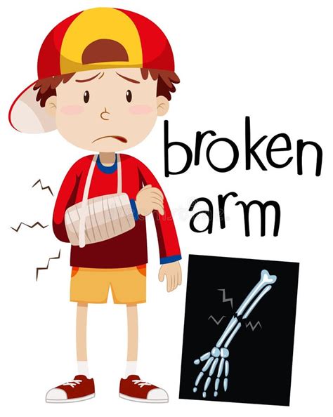 Bone Fracture Cartoon