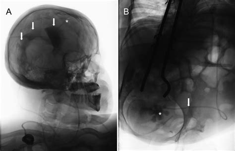 Shuntogram utility in predicting future shunt failures in: Journal of Neurosurgery: Pediatrics ...