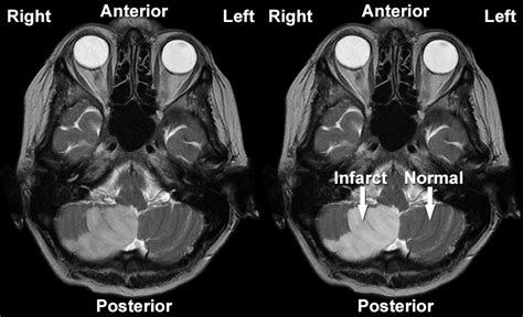 MRI Gallery - MRI Brain - Cerebellar infarct