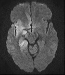 Pathology Outlines - Herpes simplex encephalitis