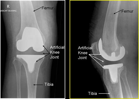 Knee replacements