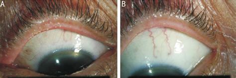 Left eyelid margin and bulbar conjunctiva of a patient with meibomian... | Download Scientific ...