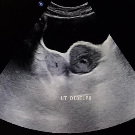 Ultrasound showing uterus didelphys postnatally on day 7 | Download Scientific Diagram