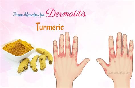 23 Natural Home Remedies For Dermatitis Symptom Relief