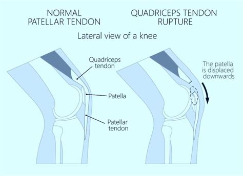 Knee Treatments Archives - Benedict Nwachukwu, MD, MBA | Hip, Knee & Shoulder Specialist ...