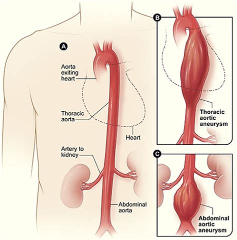 Iliac Artery - Common iliac artery, Internal & External iliac artery branches