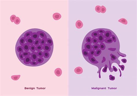 Malignant Tumor Diagram