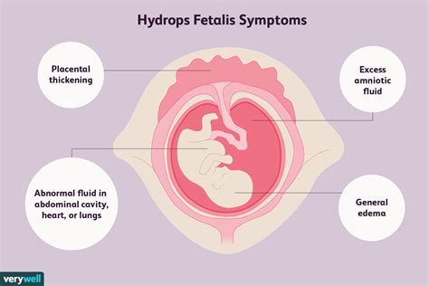 Uma Visão Geral Da Hidropsia Fetal | 2024