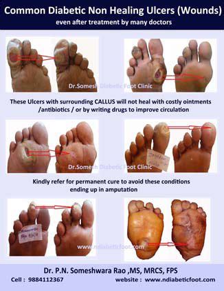 Diabetic Foot Ulcers - Podiatry Doctor