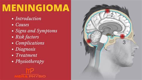 Meningioma | Intro, Causes, Symptoms, Complications, Diagnosis, Physiotherapy Treatment| Mera ...