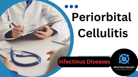 Periorbital Cellulitis: Understanding, Managing, and Preventing It